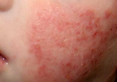 симптомы аллергического дерматита у детей, фото 2