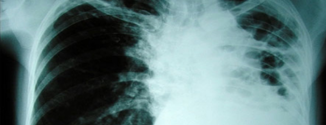 analizy-pri-tuberkuleze-legkix 