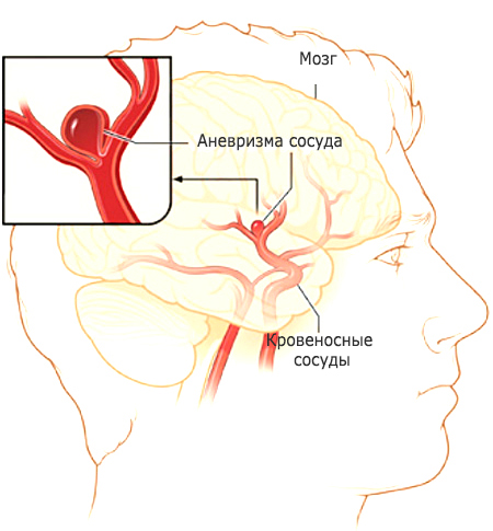 Аневризма судин головного мозку