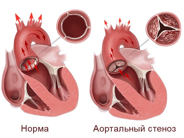 aortic-valve-stenosis