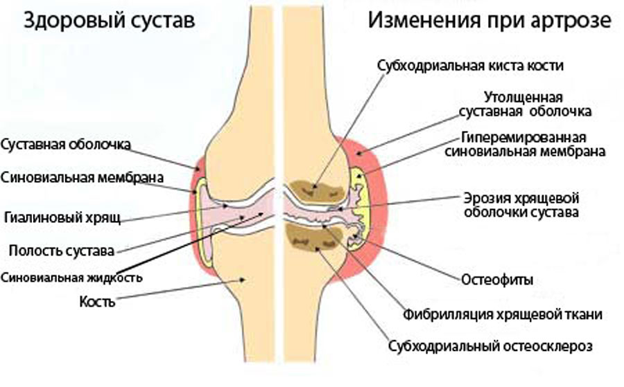 artroz-sustavov