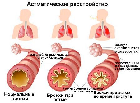 Воспаление бронхов при астме