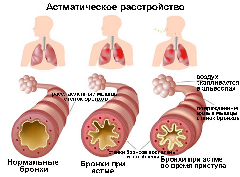 astmaticheskoe-rasstroistvo