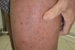 atopicheskij dermatit-2