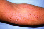 atopicheskij dermatit-6