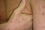 atopicheskij dermatit-9