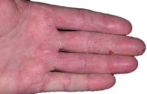 Атопический дерматит на пальцах