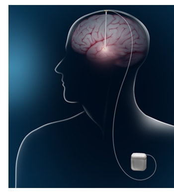 Глибока стимуляція мозку при лікуванні хвороби Паркінсона