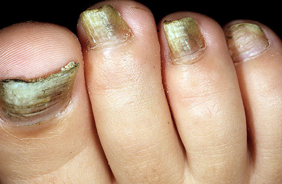 заболевание ногтей, вызванное плесневыми грибками