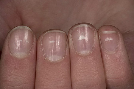 белые пятна на ногтях