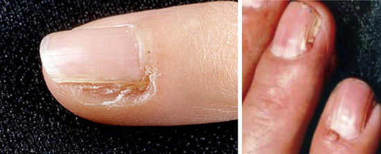 болезни ногтей
