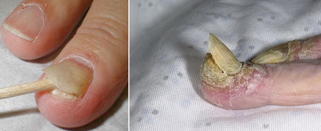 болезни ногтей