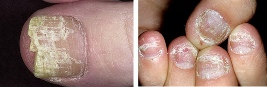 болезни ногтей онихомикоз и псориаз