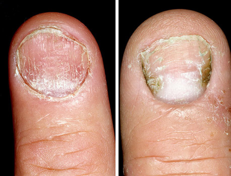 болезни ногтей - псориаз и экзема