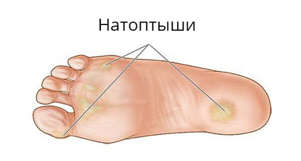 bolyat-sustavy-bolshih-paltsev-nog