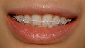 Брекеты – это скобы, которые одеваются на зубы, с целью их выравнивая или для исправления неправильного прикуса