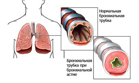 бронхи при бронхиальной астме