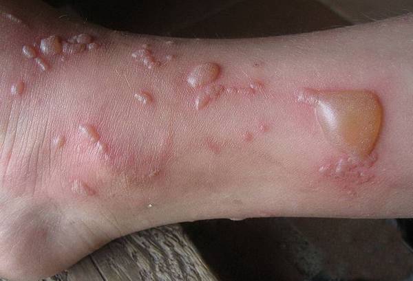 Симптомы буллезного дерматита