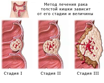 Три стадии рака