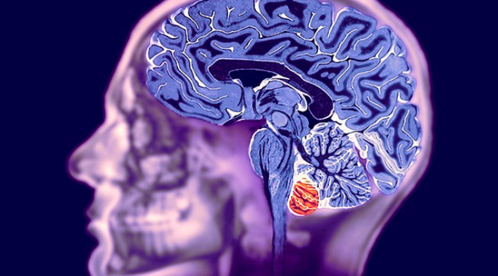 Магнитно-резонансная томография мозга:показания, противопоказания