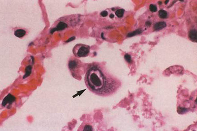 цитомегаловирусная клетка