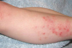 Атопический дерматит на ноге