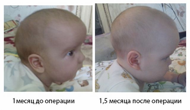 До и после операции по коррекции черепа
