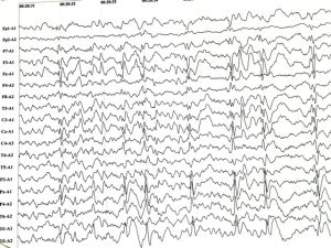 Диагностика доброкачественной миоклонической эпилепсии