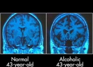 мозг здорового человека и алкоголика