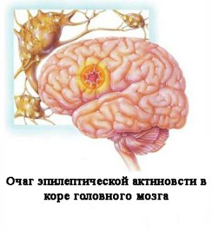 активность эпилепсии в мозгу
