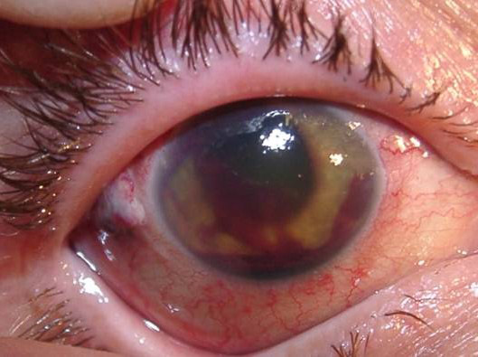 туберкулез глаз