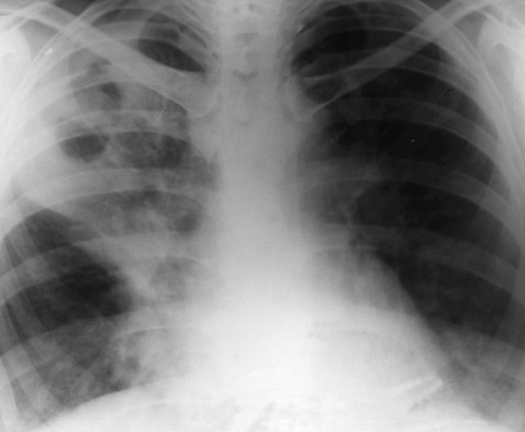 инфильтративная форма туберкулеза