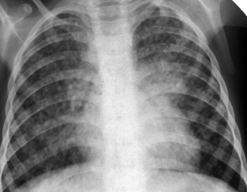острая диссеминированная форма туберкулеза