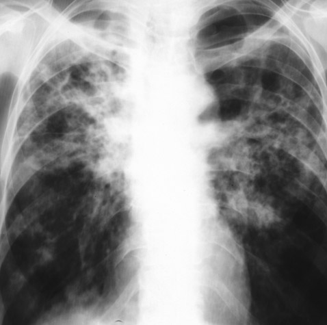 хроническая диссеминированная форма туберкулеза