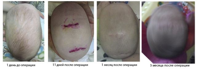 до и после операции по коррекции черепа