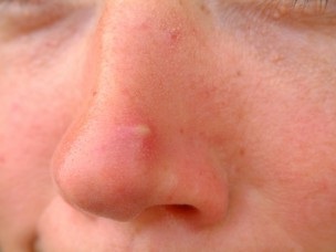 Как лечить фурункул на носу?
