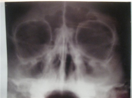 Рентген при двухстороннем гайморите