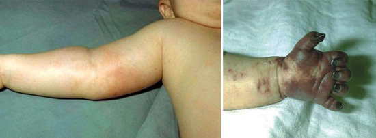 кровоизлияния при гемофильном сепсисе у детей