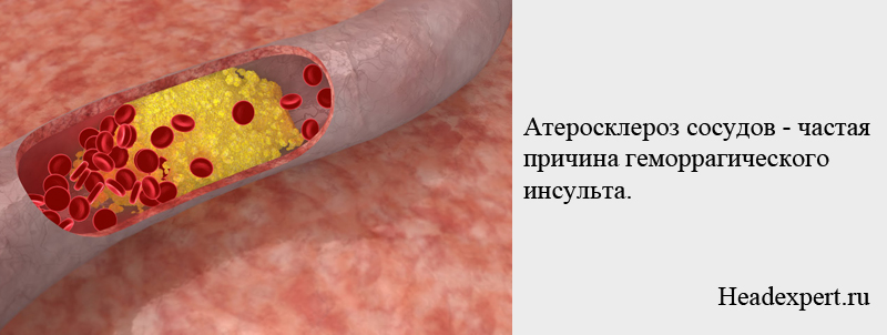 Атеросклероз - частая причина геморрагического инсульта