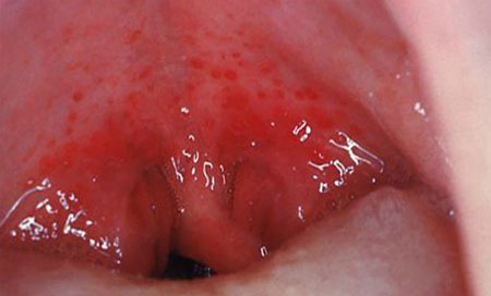 Фото горла при герпетической ангине