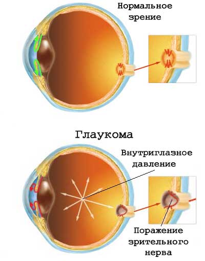 glaukoma2