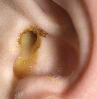 Выделение гноя из уха