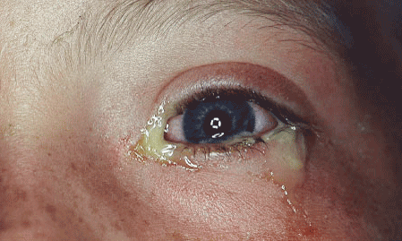Глазо-железистая форма