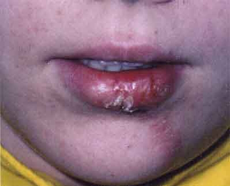 гонорея: поражение слизистой оболочки губ