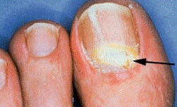Признаки поражения ногтя