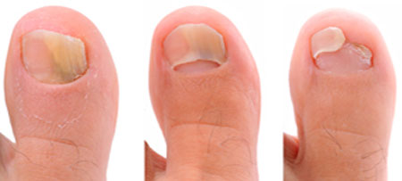 стадии развития b симптомы грибкового поражения ногтя