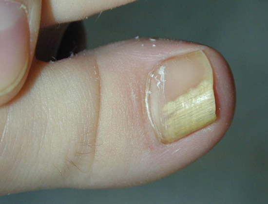 грибок ногтя большого пальца ноги