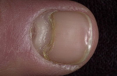 вид ногтя после травмы