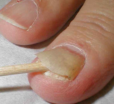 отделение ногтевой пластины 