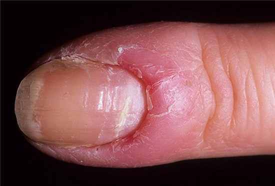 воспаление вокруг пальца (паронихия)